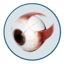 Eye Plate S platedesigd